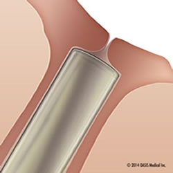 OASIS SOFT PLUG® Collagen Punctal Plugs - Box of 60